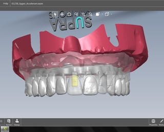 From the design the framework is built and individual crowns are placed.