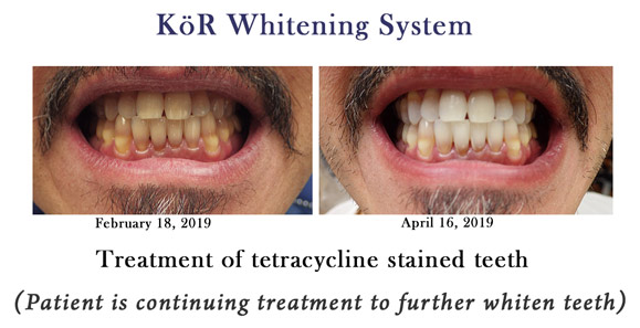 Before and after photos of a patient's teeth using the KöR Whitening System.